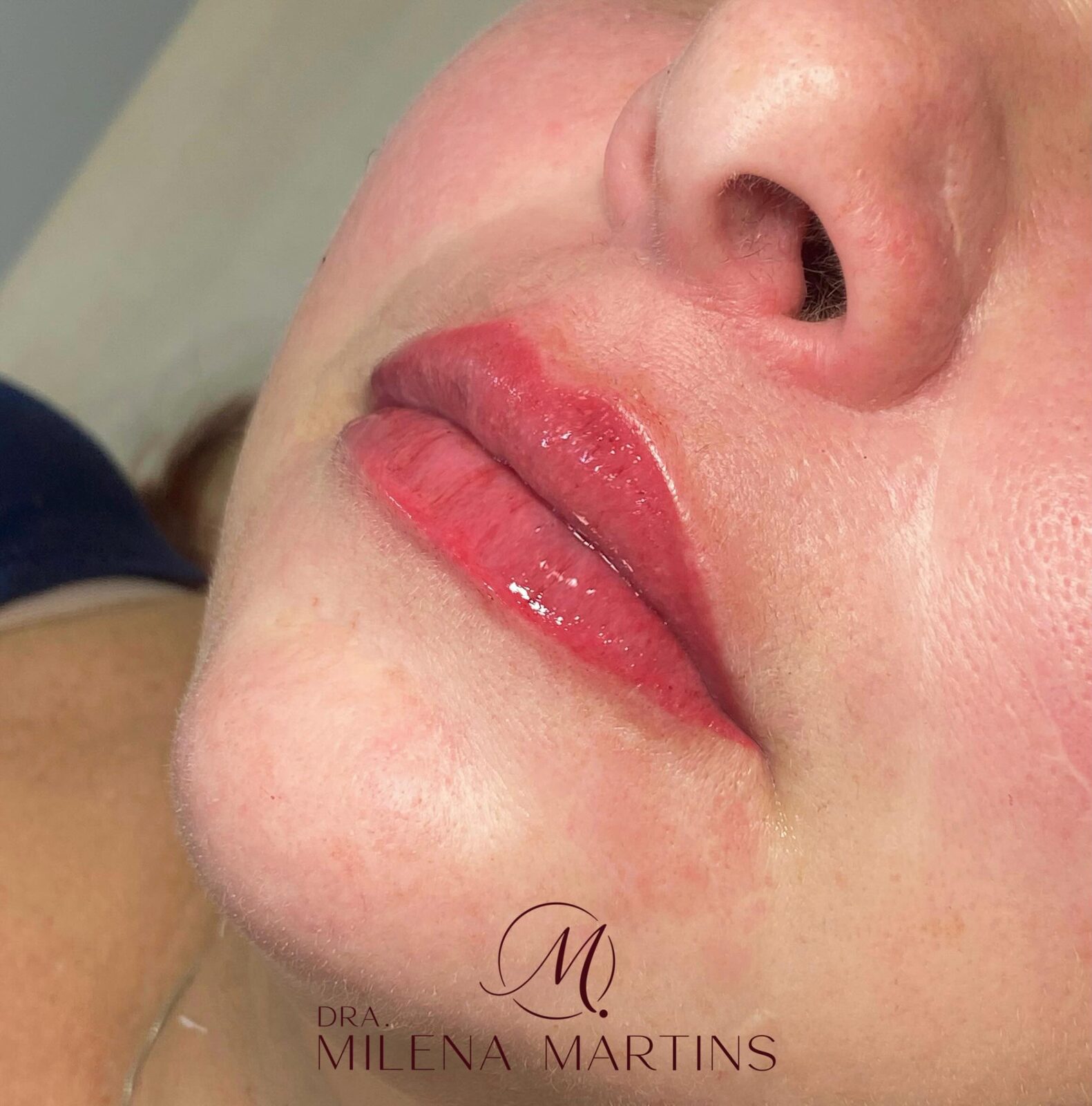 Procedimento labial